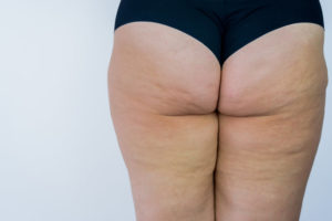 como tratar celulite