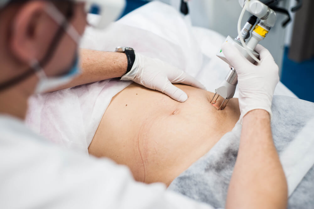 tratamento estrias laser fracionado